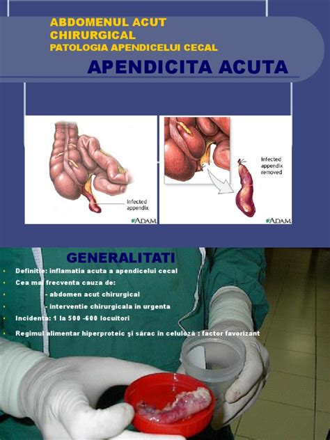 apendicita acuta|Apendicită